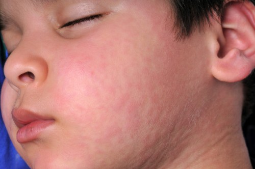 Mumps parotitis in child