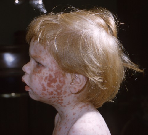 1966The young boy pictured here, displayed the characteristic maculopapular rash indicative of rubella, otherwise known as German measles, or 3-day measles. Rubella is a respiratory viral infection characterized by mild respiratory symptoms and low-grad