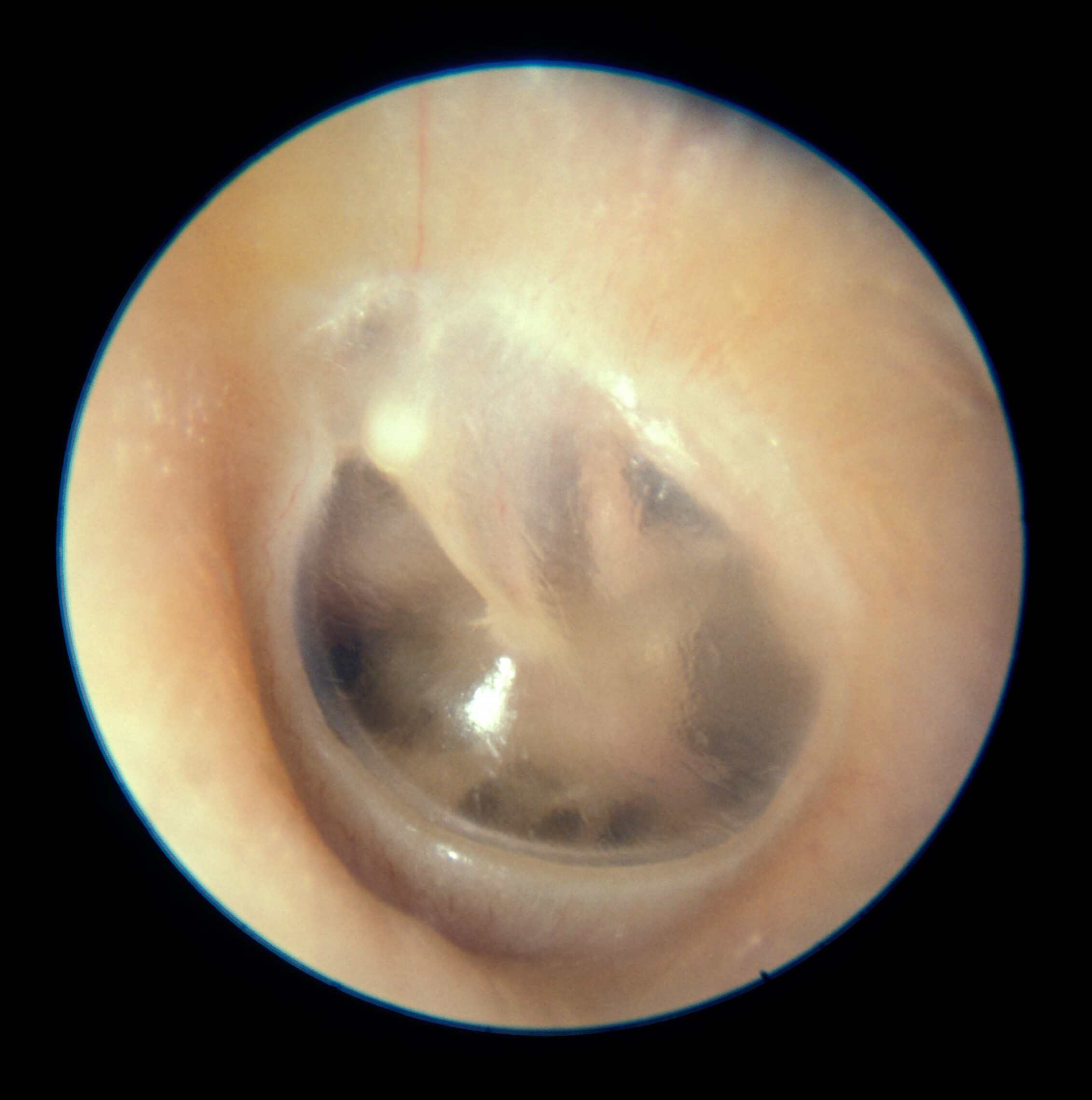 Baby Eardrum Development: Understanding the Importance