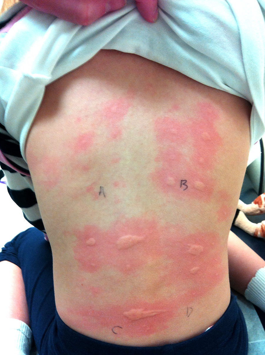 boy-skin-test-allergy